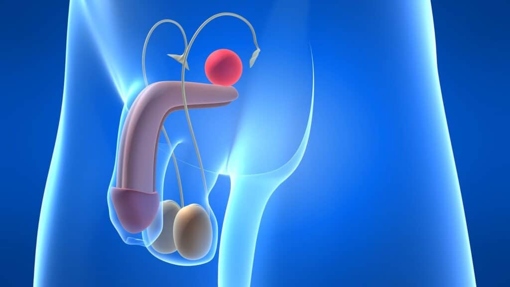 embolizzazione prostata